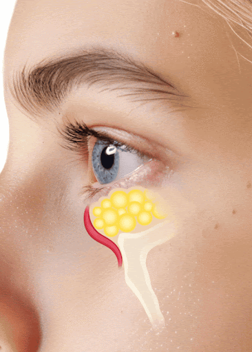 Emface Eye Bag Reduction at Pollard Preventative Los Gatos