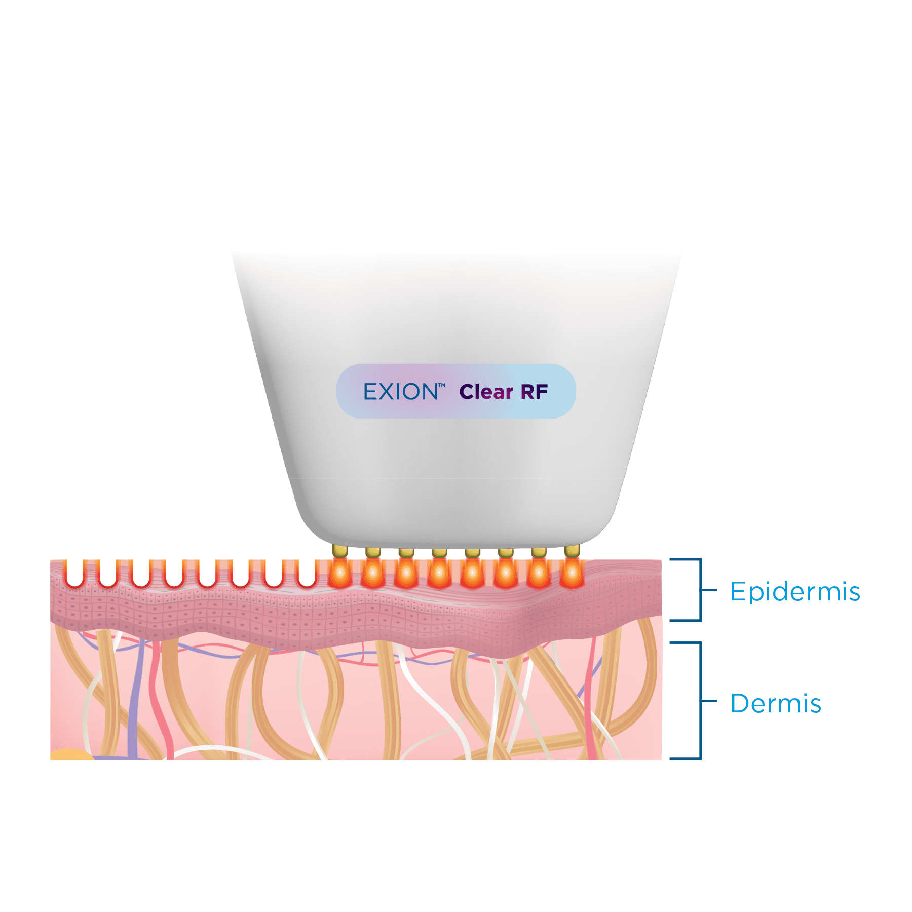 Exion Clear RF Sun Damage Skin Pigmentation Treatment at Pollard Preventative Los Gatos