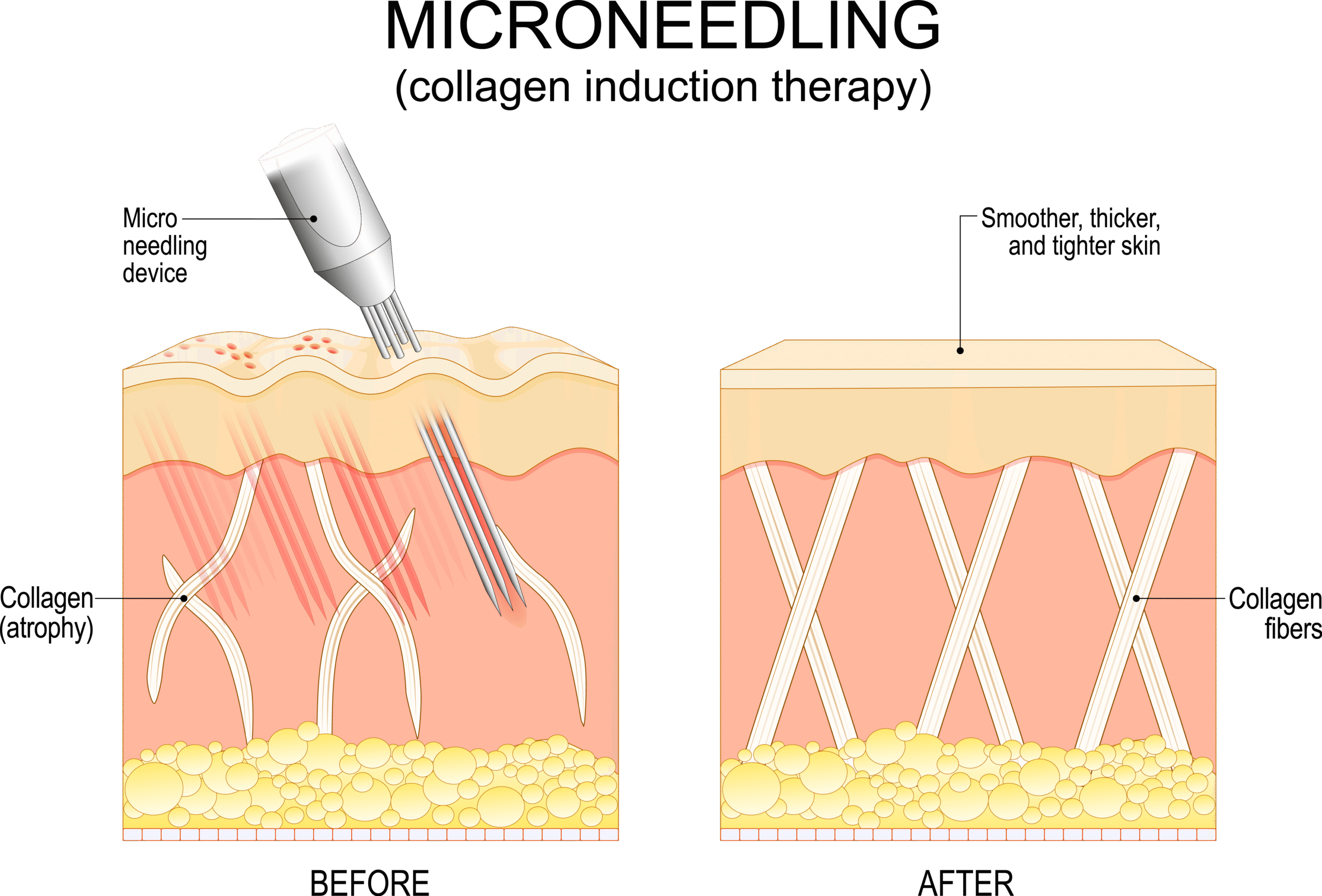 How RF Microneedling Works for Wrinkles and Fine Lines Infographic Pollard Preventative Los Gatos