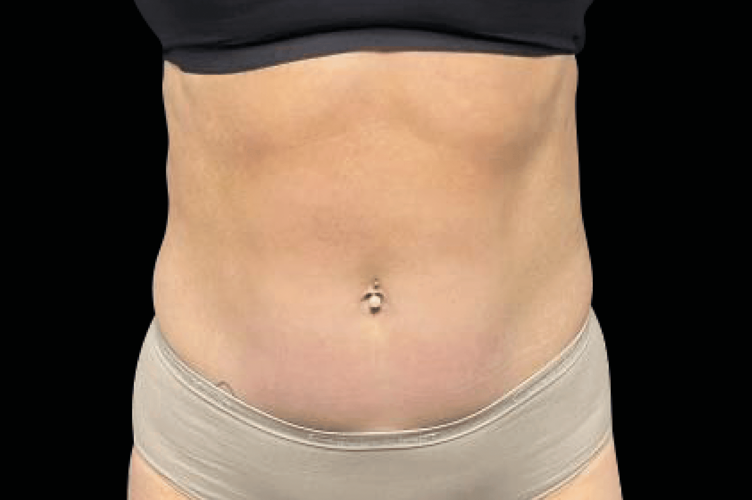 Emsculpt NEO body sculpting stubborn fat reduction and muscle building at Pollard Preventative Los Gatos