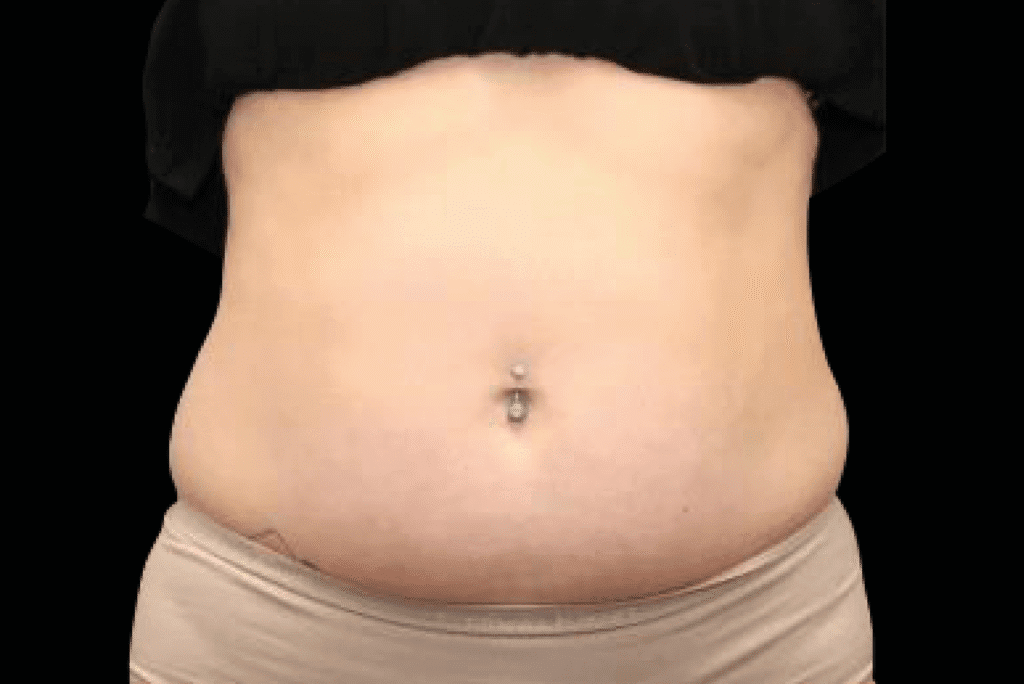 Emsculpt NEO body sculpting stubborn fat reduction and muscle building at Pollard Preventative Los Gatos