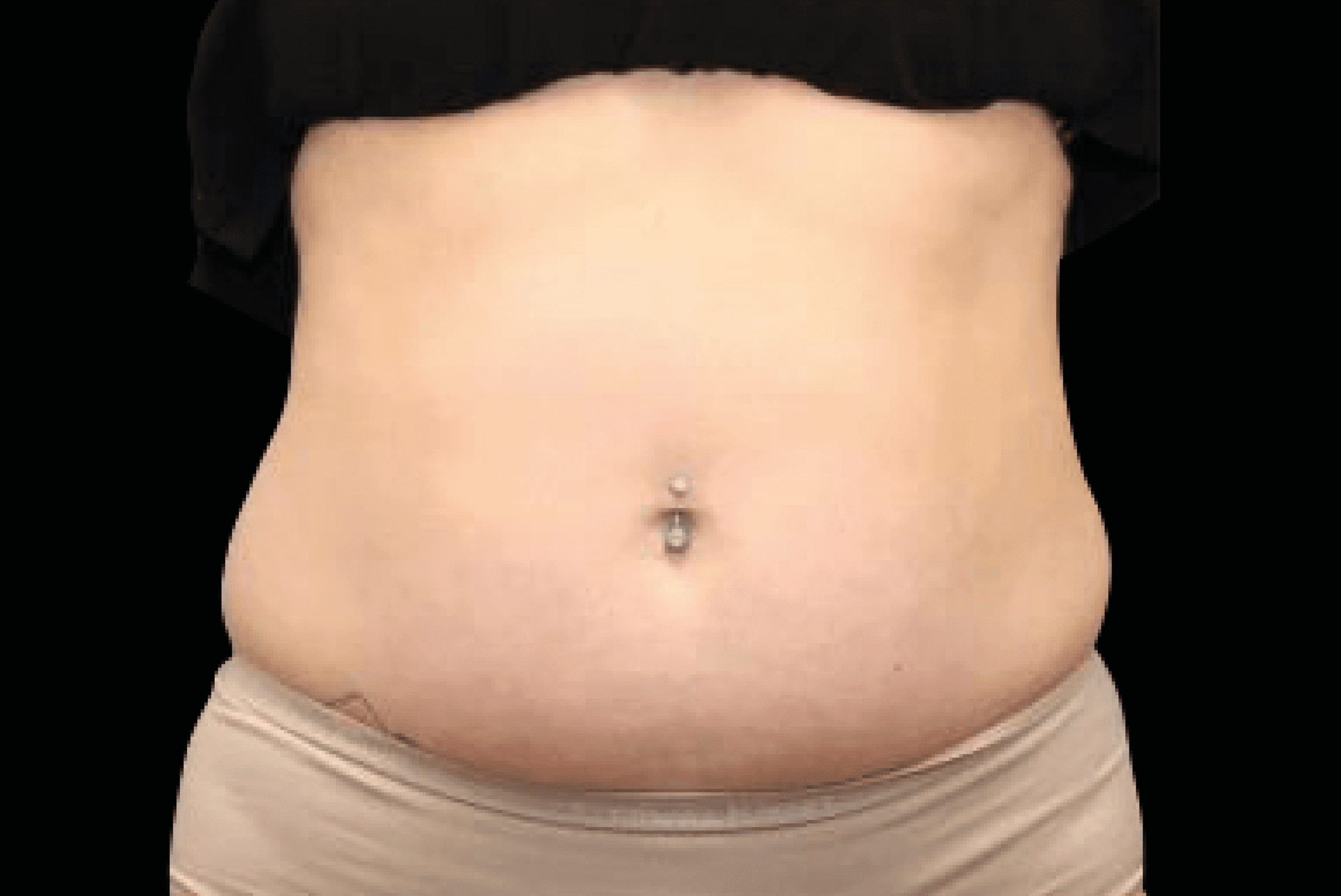 Emsculpt NEO body sculpting stubborn fat reduction and muscle building at Pollard Preventative Los Gatos