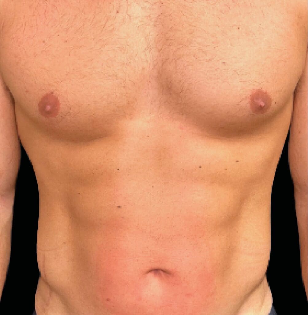 Emsculpt NEO body sculpting stubborn fat reduction and muscle building at Pollard Preventative Los Gatos