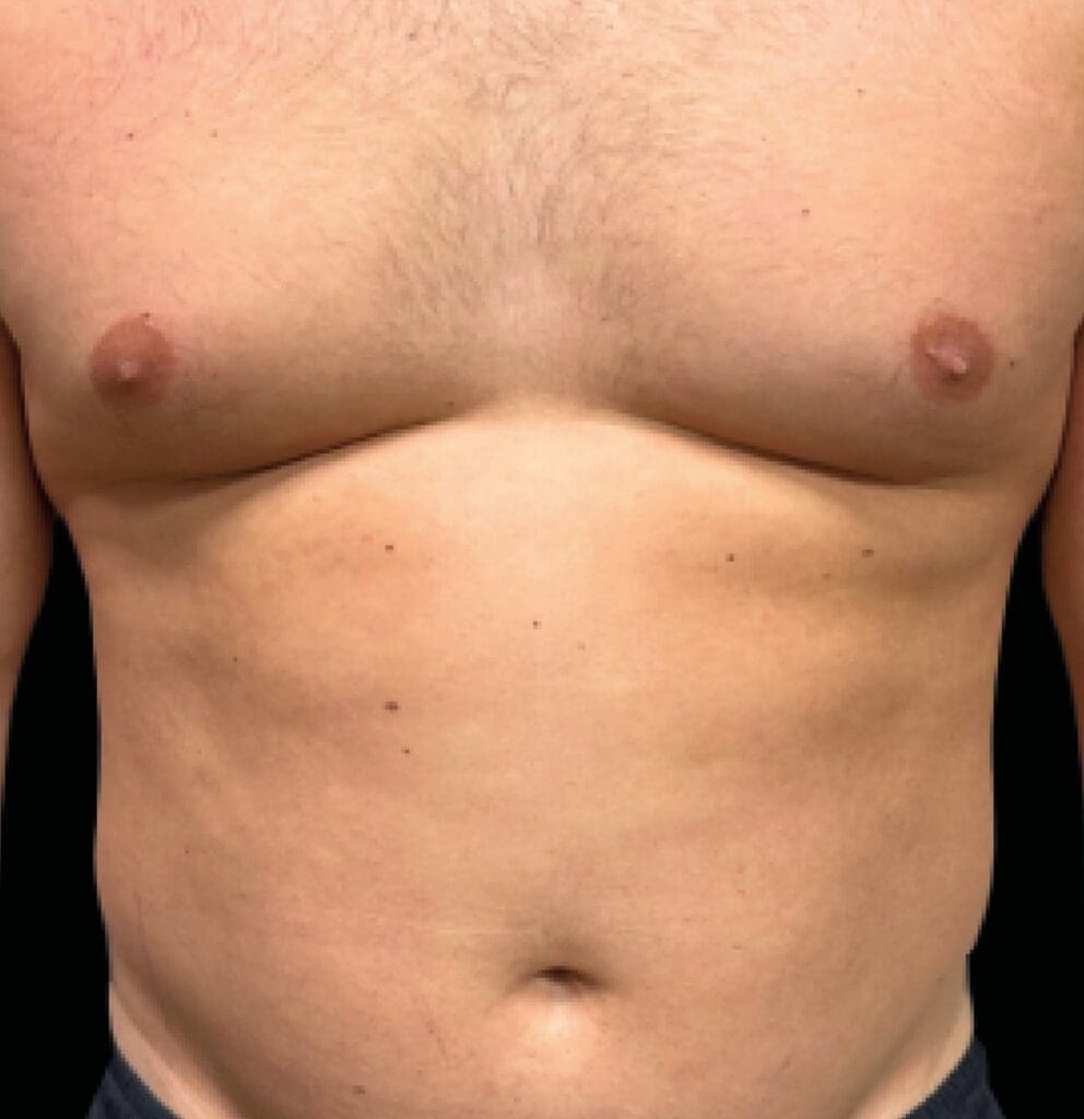 Emsculpt NEO body sculpting stubborn fat reduction and muscle building at Pollard Preventative Los Gatos