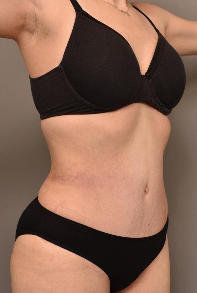 Emsculpt NEO Strengthen Deep Core pelvic floor pulls in distended bloated belly