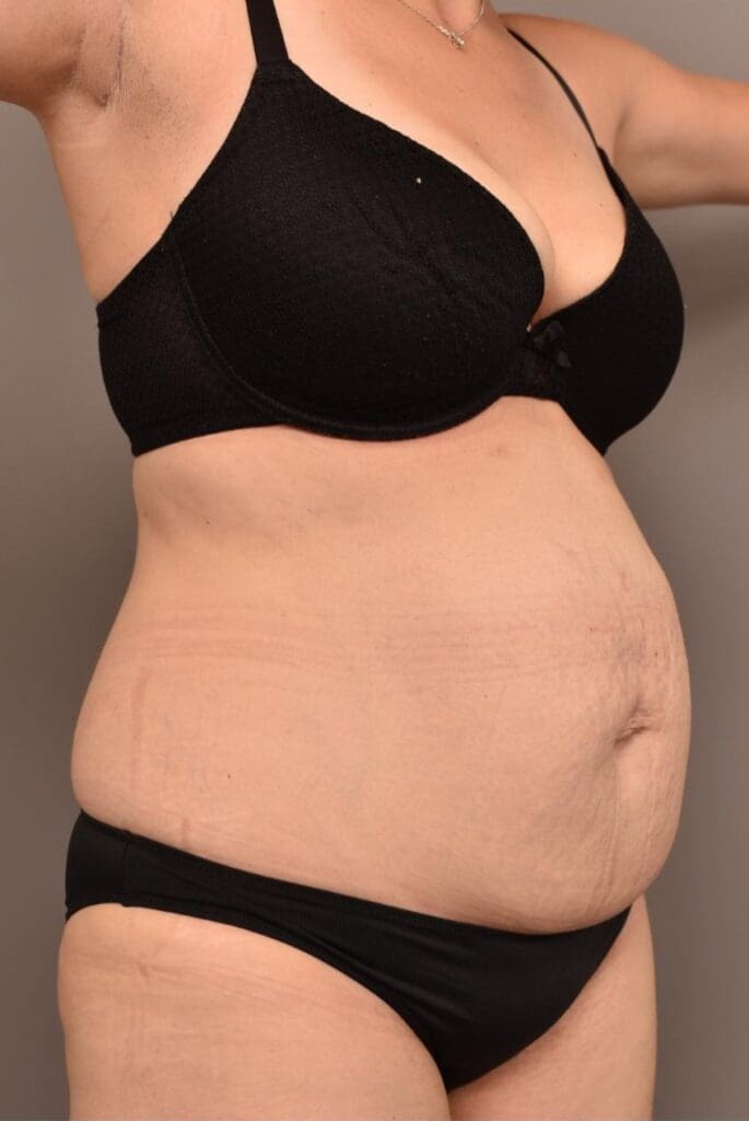 Emsculpt NEO Strengthen Deep Core pelvic floor pulls in distended bloated belly