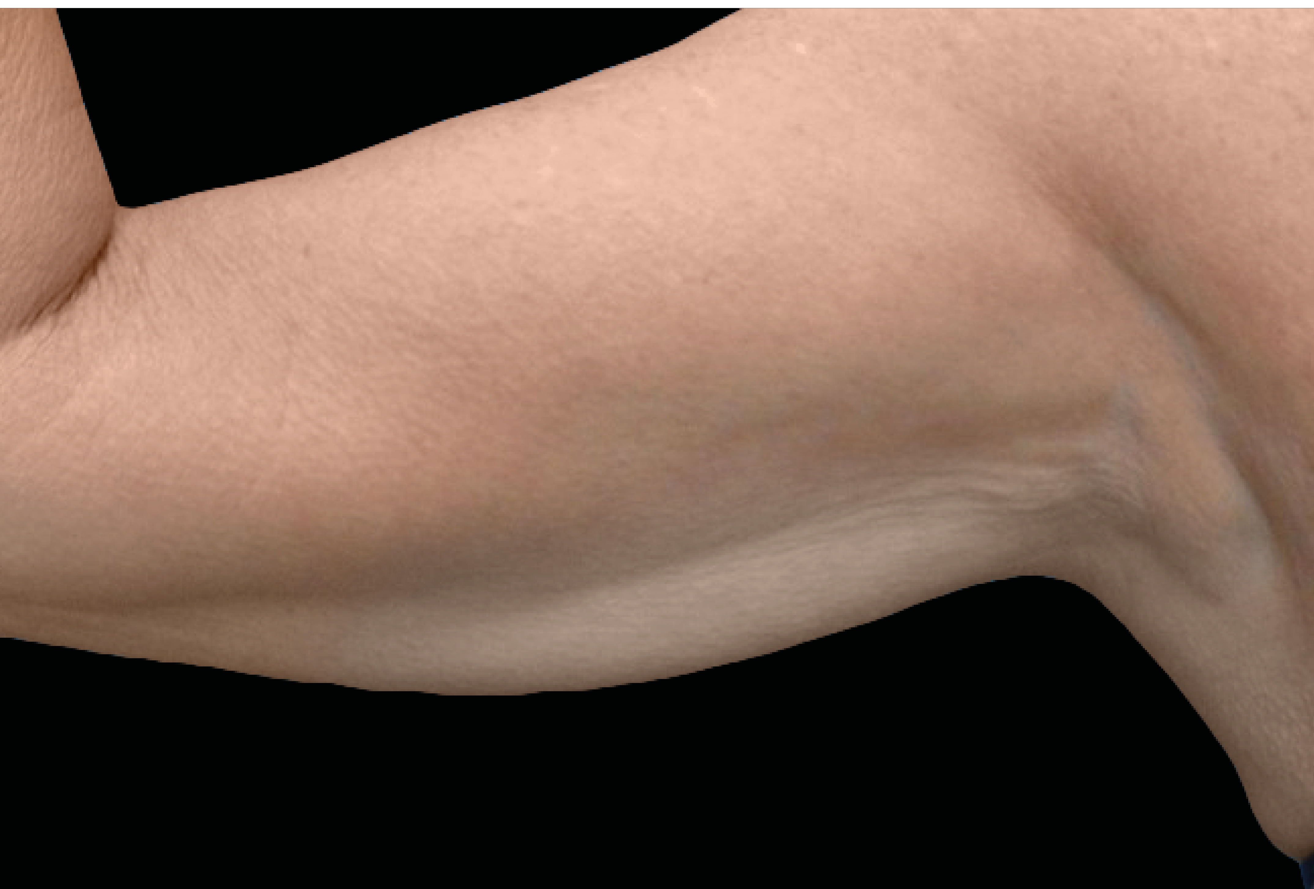 Exion Body RF + Targeted Ultrasound bra back fat removal crepey skin at Pollard Preventative Los Gatos