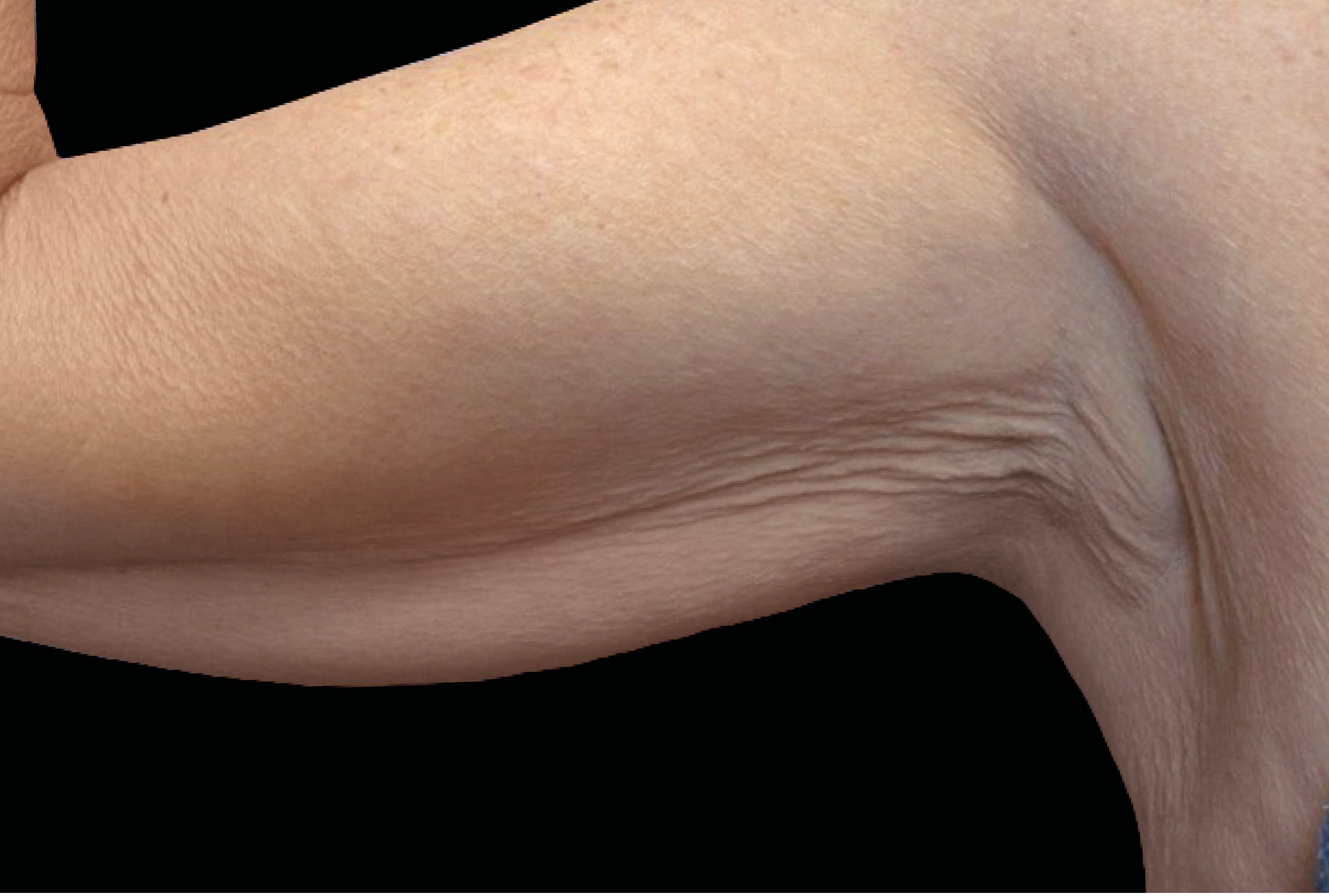 Exion Body RF + Targeted Ultrasound bra back fat removal crepey skin at Pollard Preventative Los Gatos