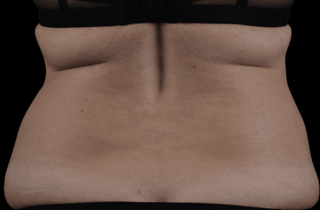 Exion Body RF + Targeted Ultrasound bra back fat removal at Pollard Preventative Los Gatos