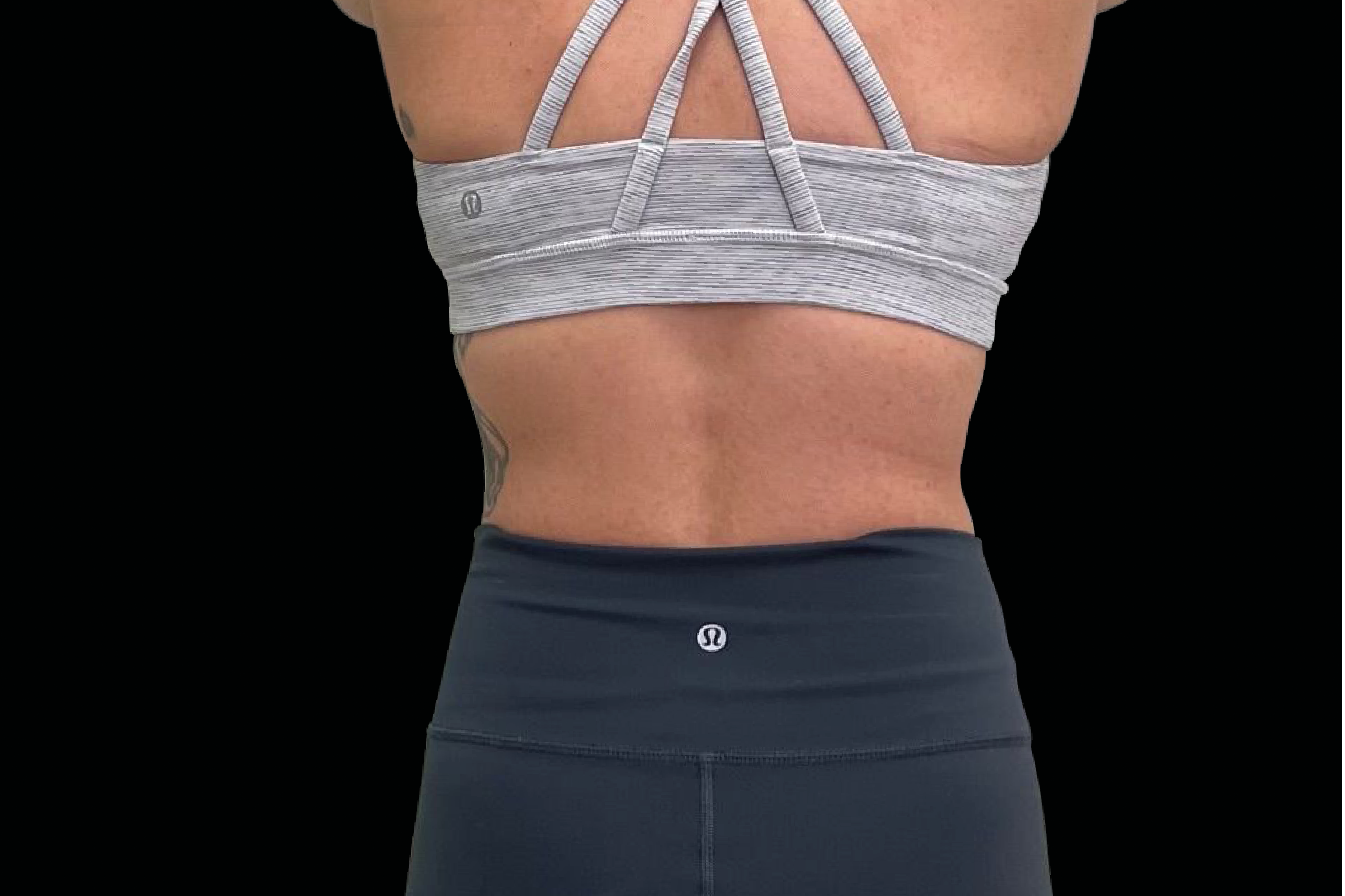 Exion Body RF + Targeted Ultrasound bra fat removal at Pollard Preventative Los Gatos