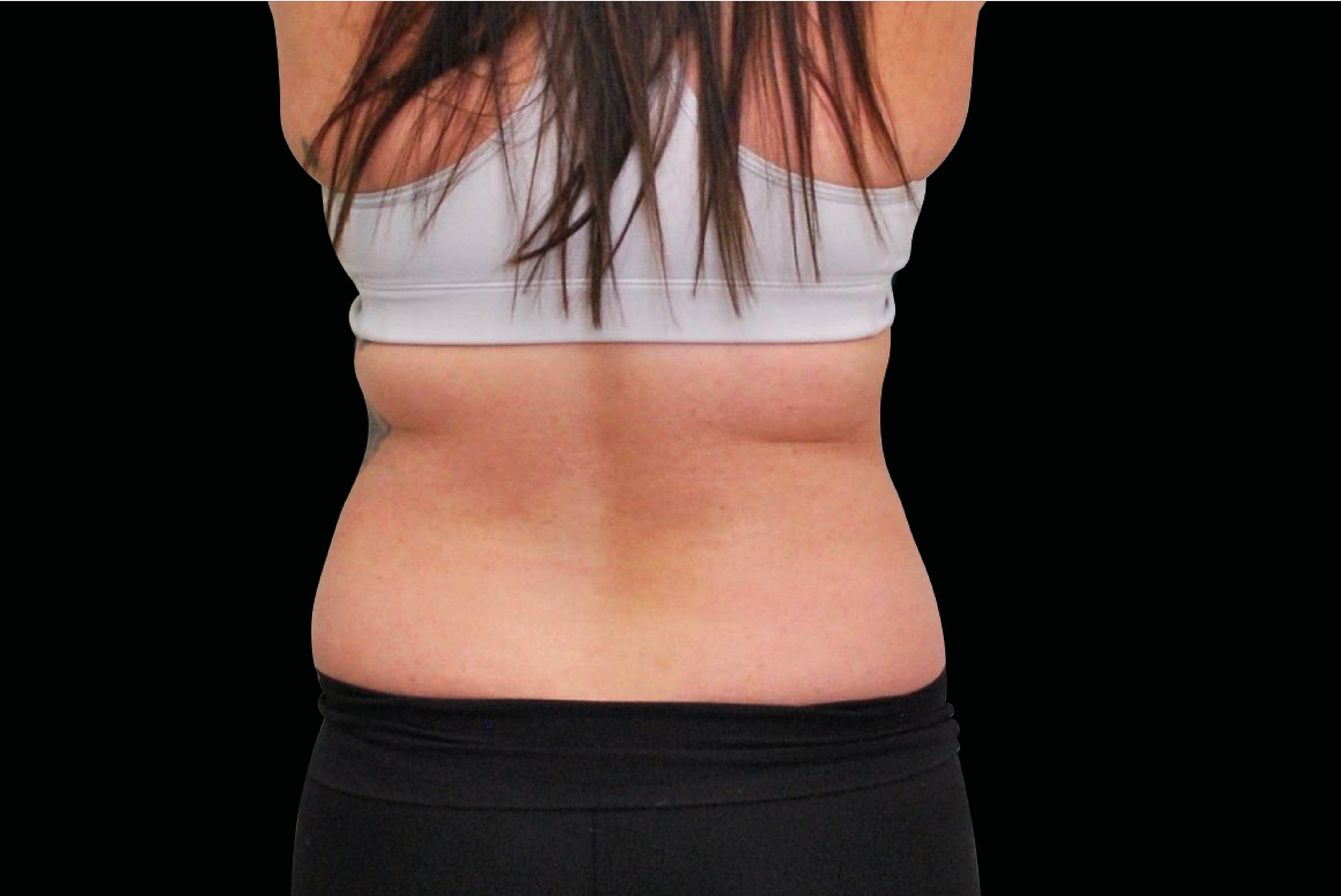 Exion Body RF + Targeted Ultrasound bra fat removal at Pollard Preventative Los Gatos