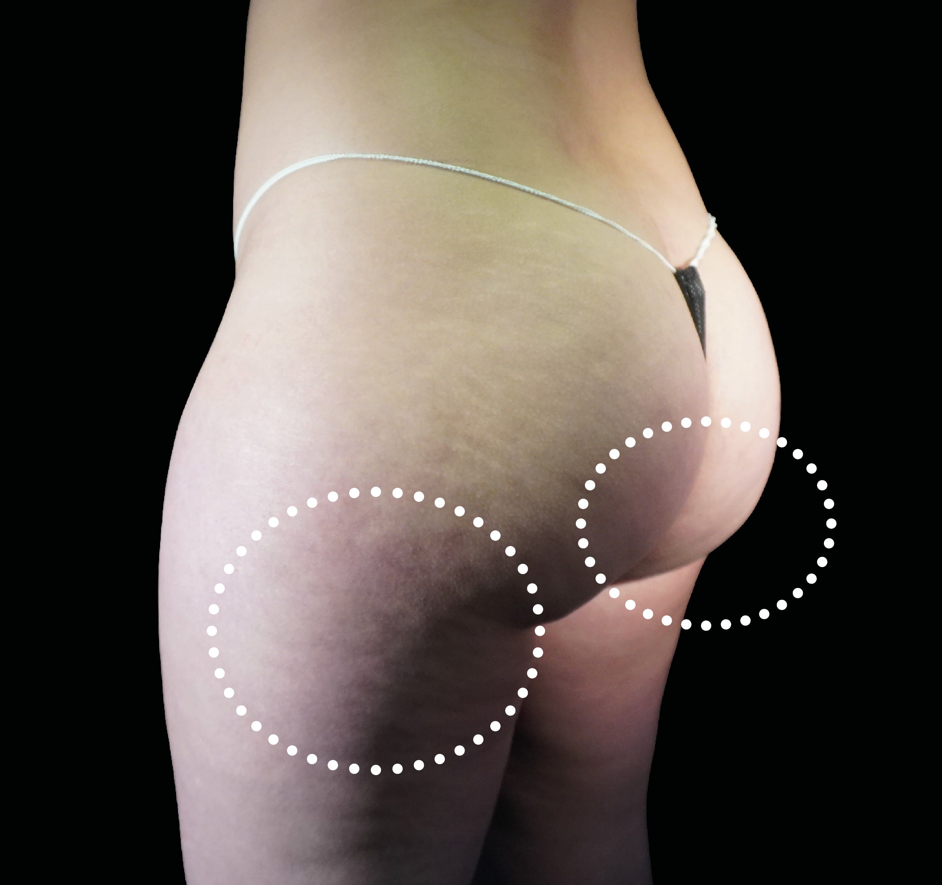 Emsculpt NEO + Exion Body for Banana Fold, Under Glute Fat Roll at Pollard Preventative in Los Gatos After pic