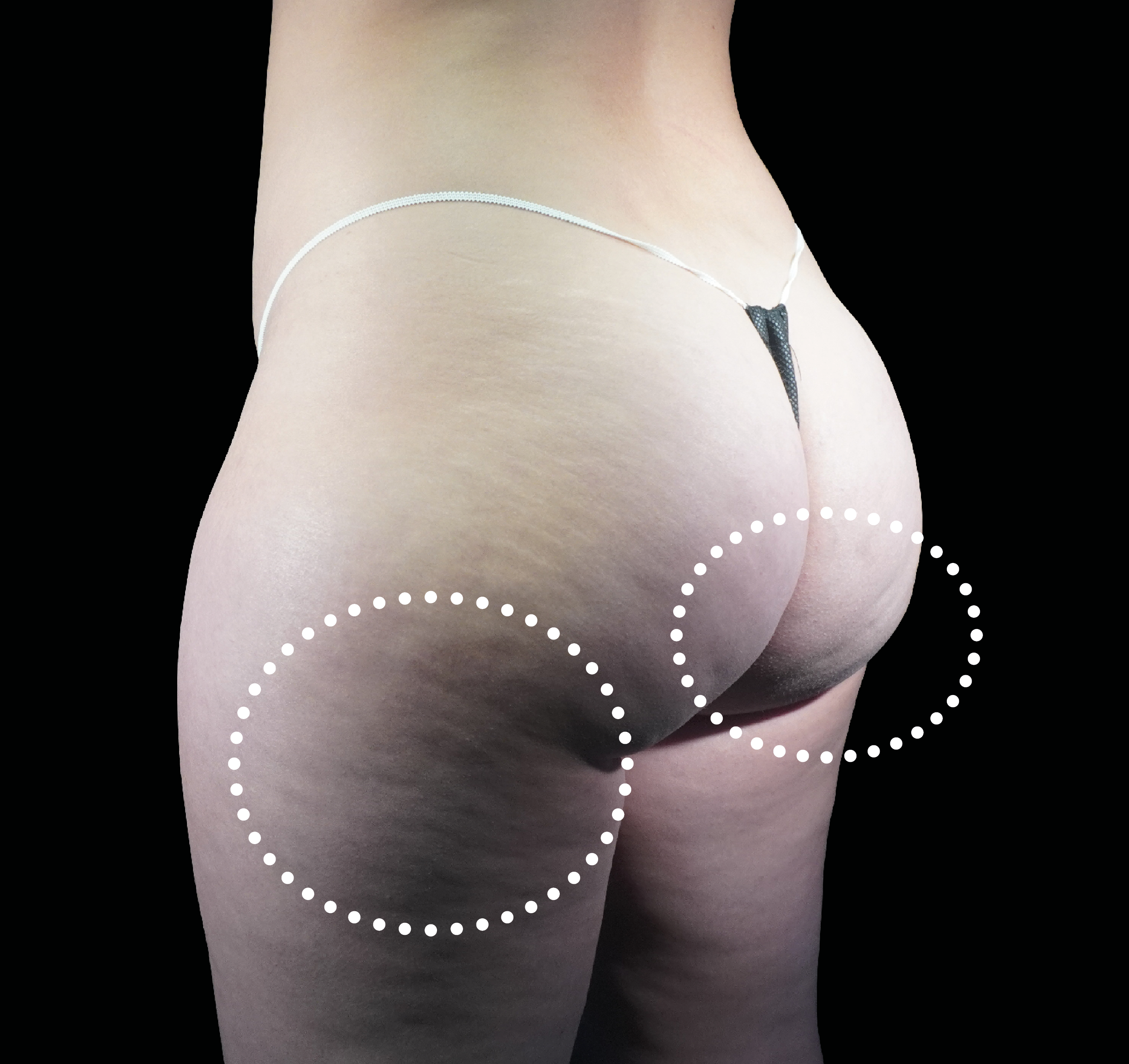 Emsculpt NEO + Exion Body for Banana Fold, Under Glute Fat Roll at Pollard Preventative in Los Gatos Before pic
