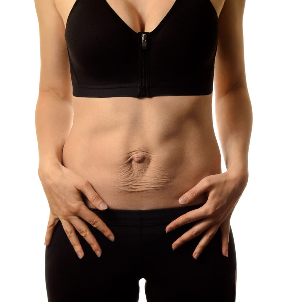 Emsculpt NEO for Diastasis Recti at Pollard Preventative in Los Gatos Before pic
