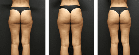 Emsculpt NEO for Hip Dips Outer Thigh Bulge at Pollard Preventative in Los Gatos How it works pic