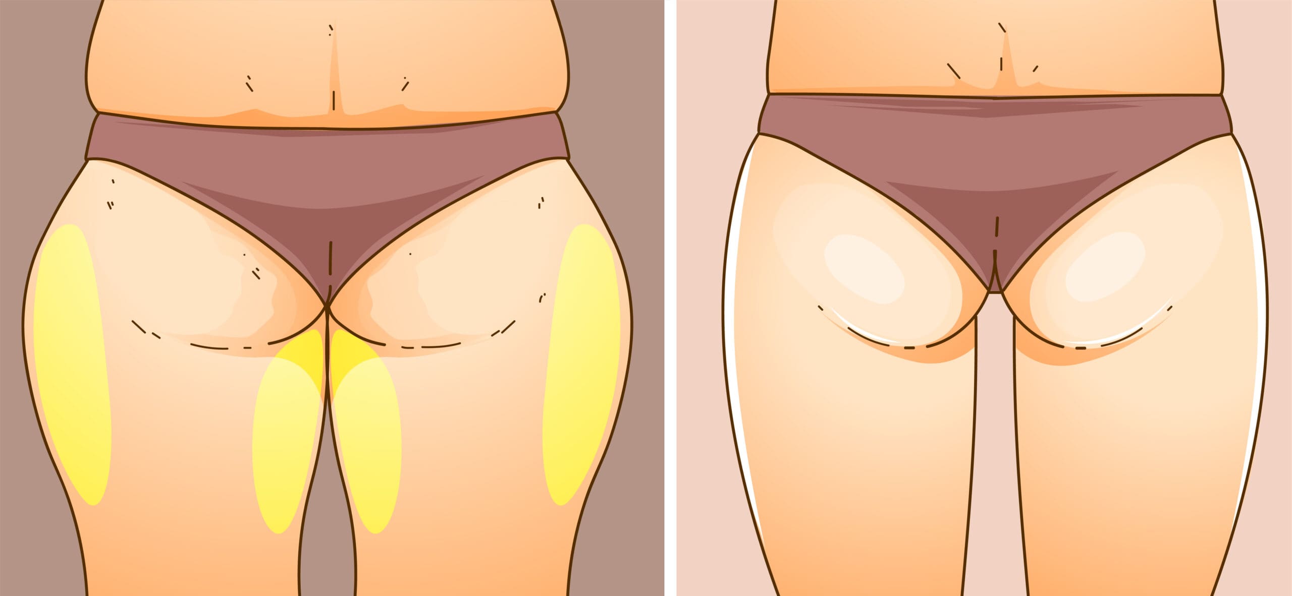 Emsculpt NEO for Hip Dips Outer Thigh Bulge at Pollard Preventative in Los Gatos How it works Back pic