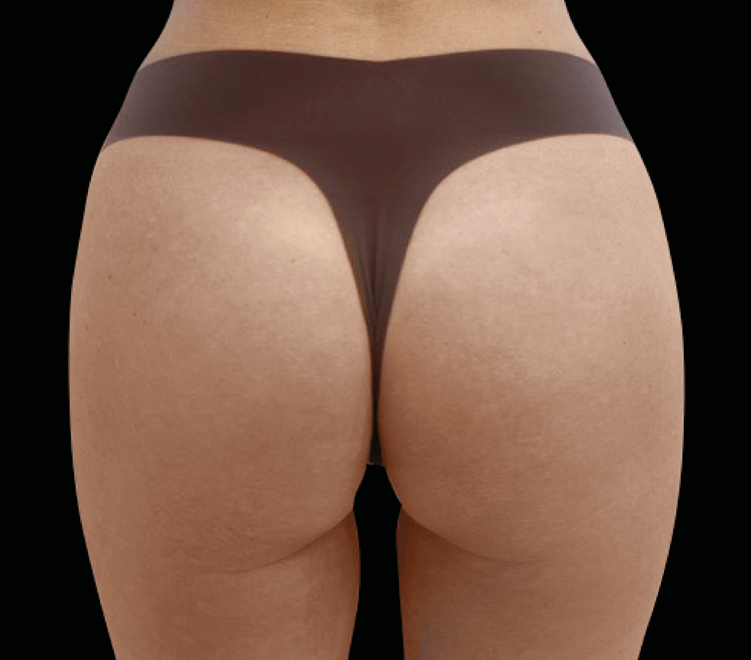 Emsculpt NEO + Exion Body for Ozempic Pancake Butt at Pollard Preventative in Los Gatos After pic