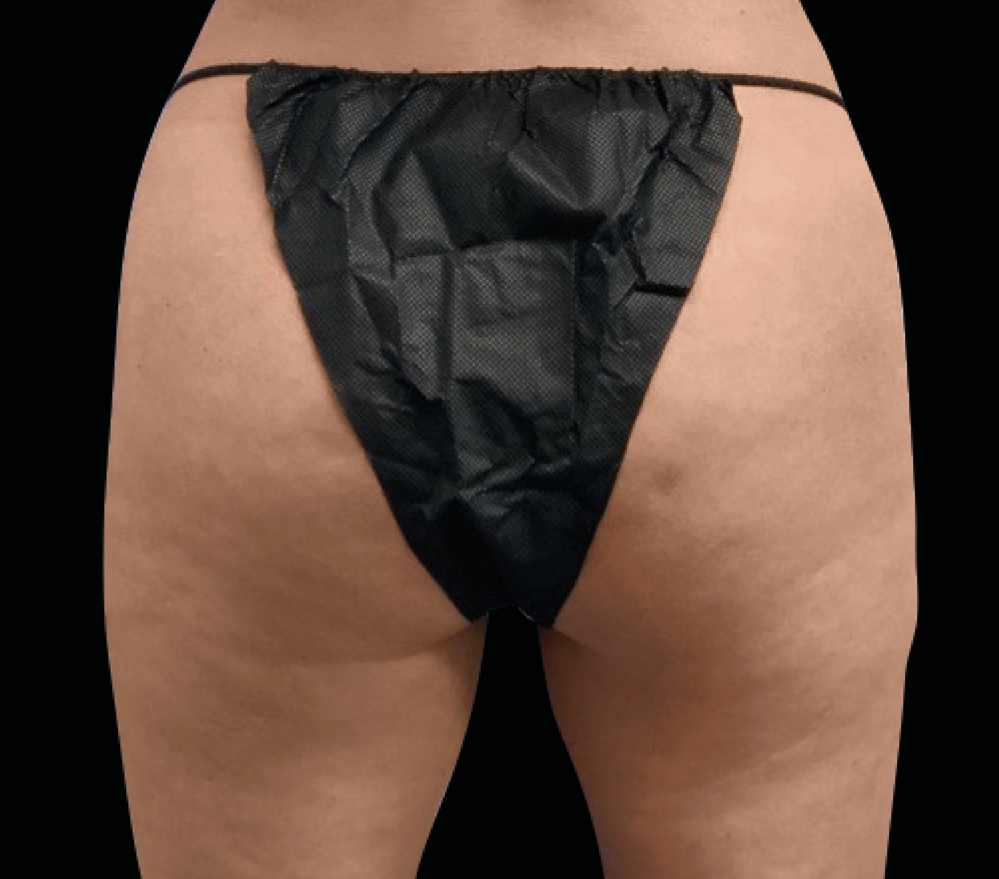 Emsculpt NEO + Exion Body for Ozempic Pancake Butt at Pollard Preventative in Los Gatos Before pic