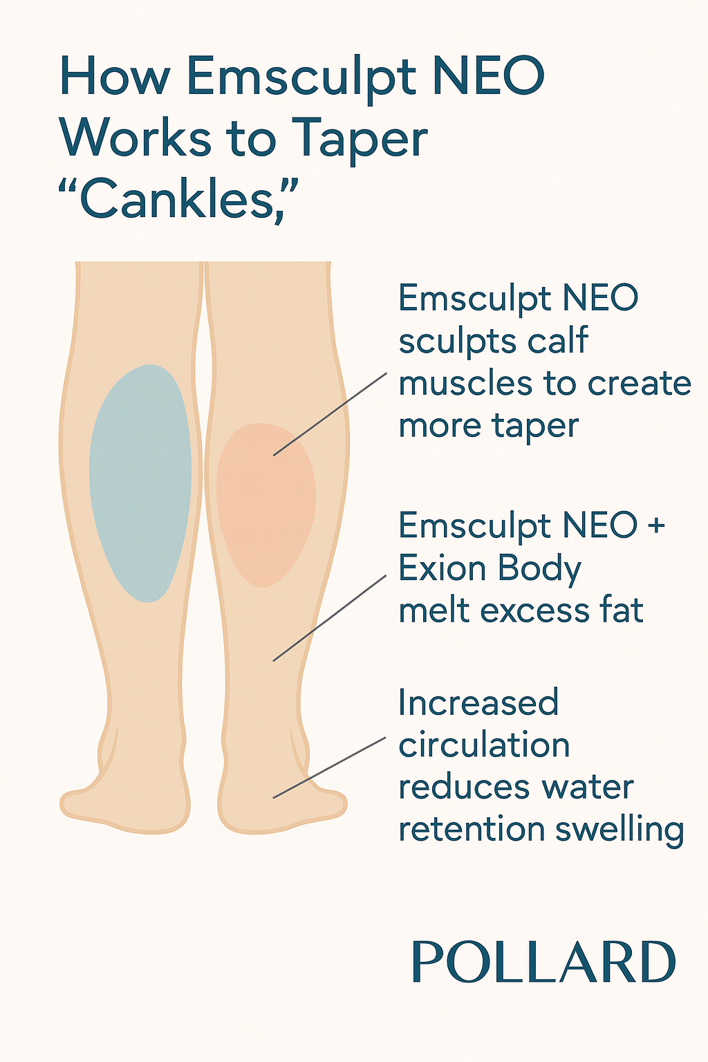 Emsculpt NEO + Exion Body for Bulky Ankles Cankles at Pollard Preventative in Los Gatos How it works Back Infographic